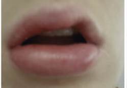 Angioedema-in-a-37-year-old-female-with-CSU-and-DPU-prior-to-omalizumab-who-became-pregnant