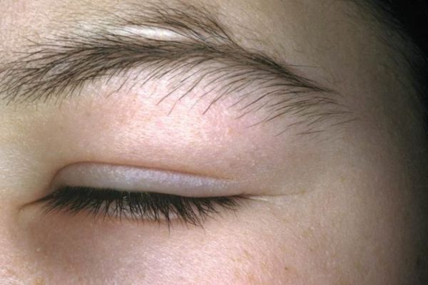 Angioedema-of-the-eye-in-a-male-patient-768x519